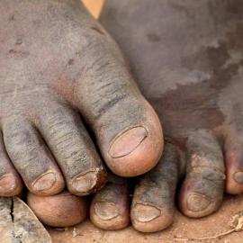 Guinea Worm Disease