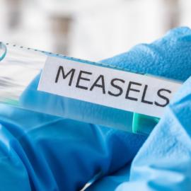Measles