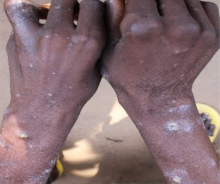 Skin lesions of Mpox disease patients – hands