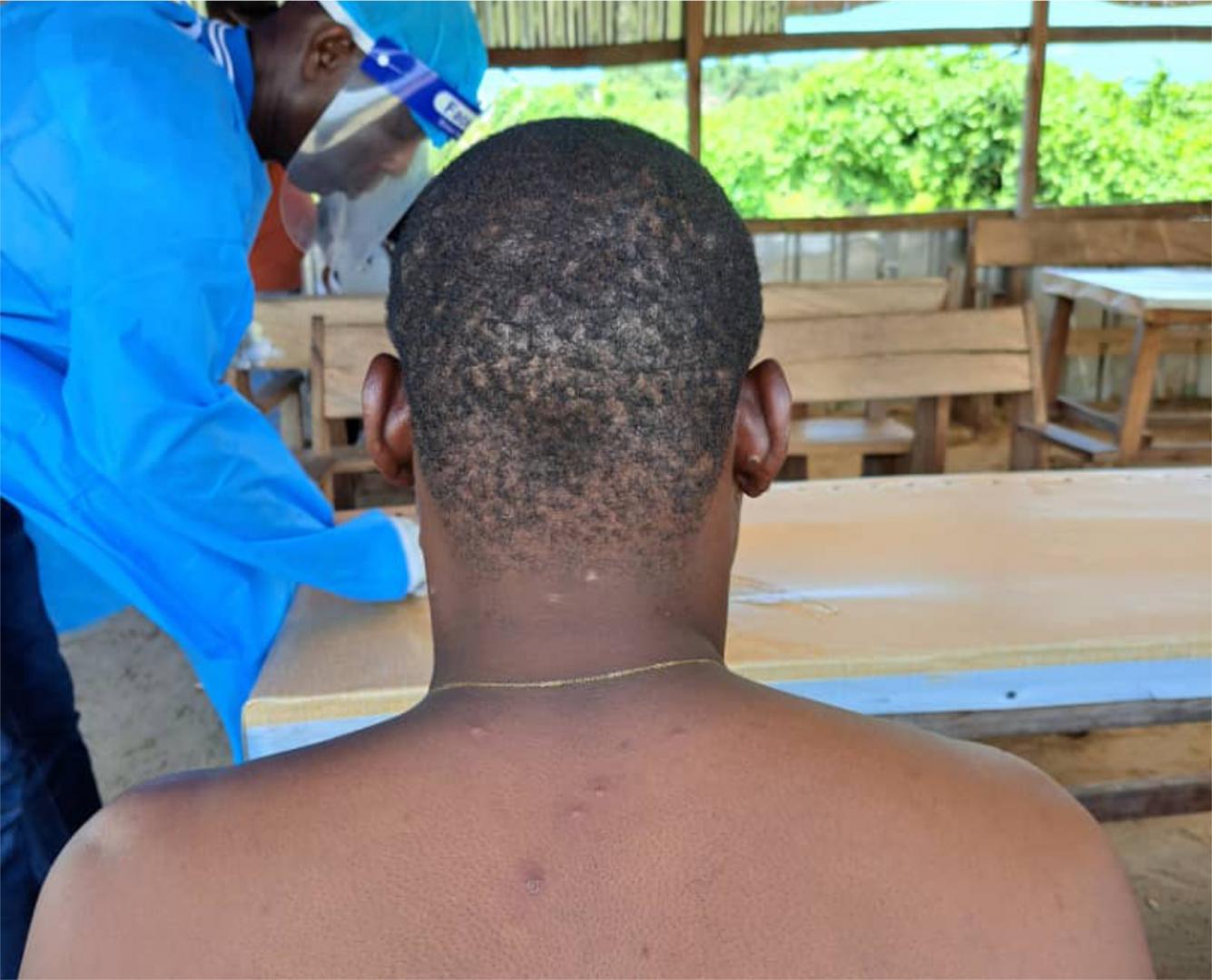 A patient with monkeypox attended to by a health worker.jpg