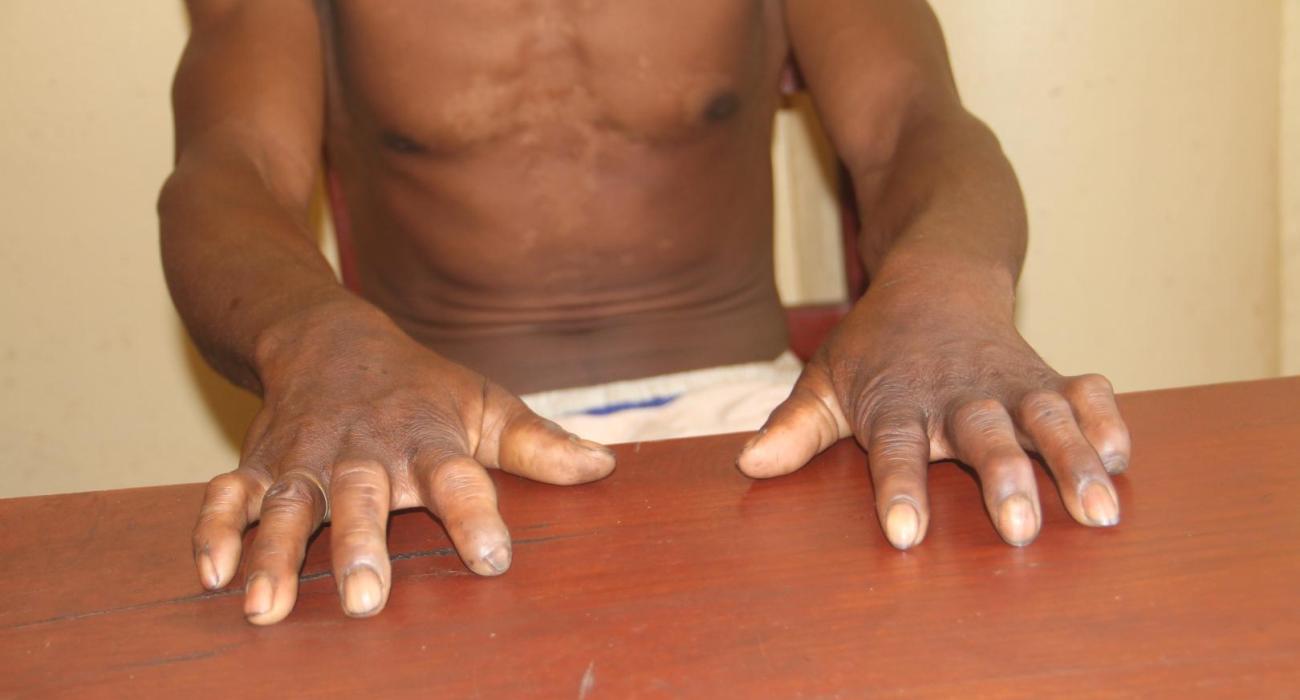 33 ans avant le diagnostic : comment l’OMS renforce la détection précoce et la prise en charge de la lèpre à Madagascar