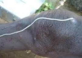 Guinea worm emerging from the patient's knee.