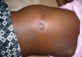 Buruli Ulcer Article_Chineye's Leg Buruli Ulcer Article_Chineye's Leg