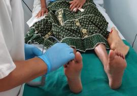 Mauritian clinics help cut diabetic foot amputations