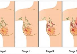 Stage of Breast Cancer