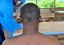 A patient with monkeypox attended to by a health worker.jpg