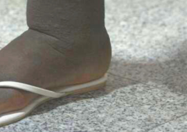 Victim living with Elephantiasis Victim living with Elephantiasis