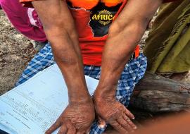 Leprosy patient treated with TB medications experiencing mild type 2 reaction Leprosy patient treated with TB medications experiencing mild type 2 reaction
