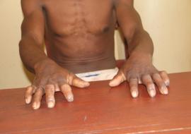 33 ans avant le diagnostic : comment l’OMS renforce la détection précoce et la prise en charge de la lèpre à Madagascar