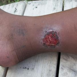 Buruli ulcer
