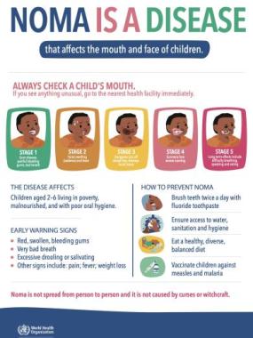 Poster for raising awareness and promoting early detection of noma
