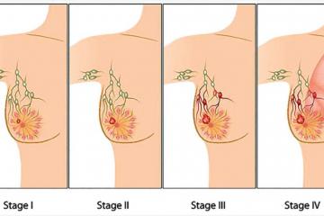 Survivors affirm that regular testing for early diagnosis is panacea to curbing cancer. thumbnail