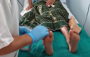 Mauritian clinics help cut diabetic foot amputations