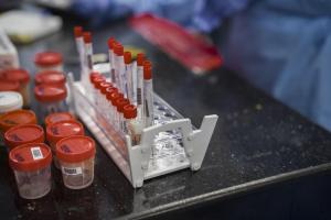Six in seven COVID-19 infections go undetected in Africa