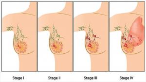 Stage of Breast Cancer