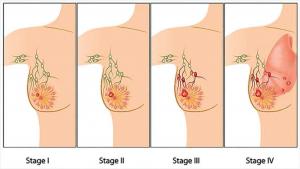 Stage of Breast Cancer