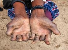 Leprosy patient cured but having grade 2 disabilities on the hands